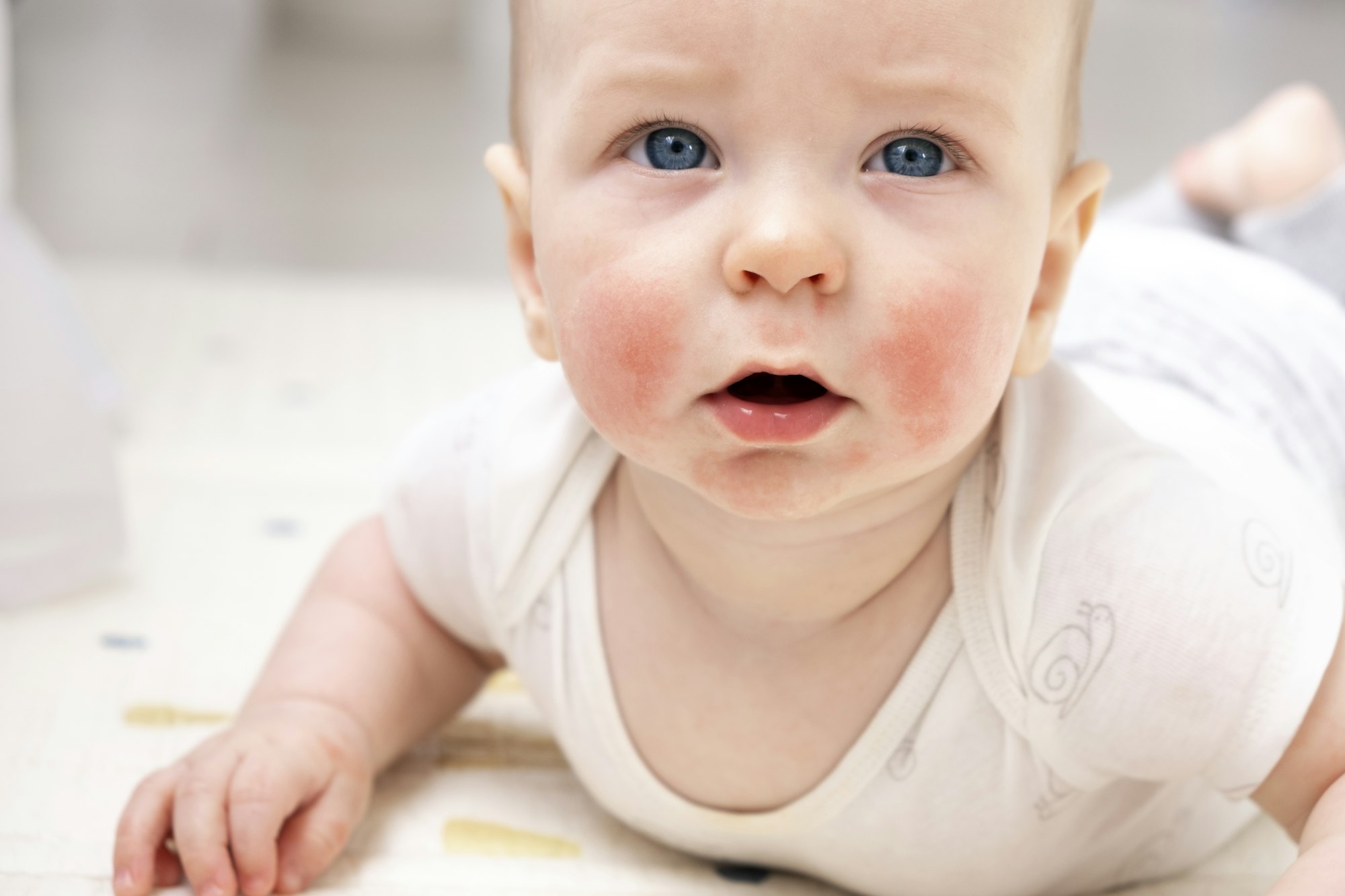 Baby face with eczema on cheeks. Atopic dermatitis