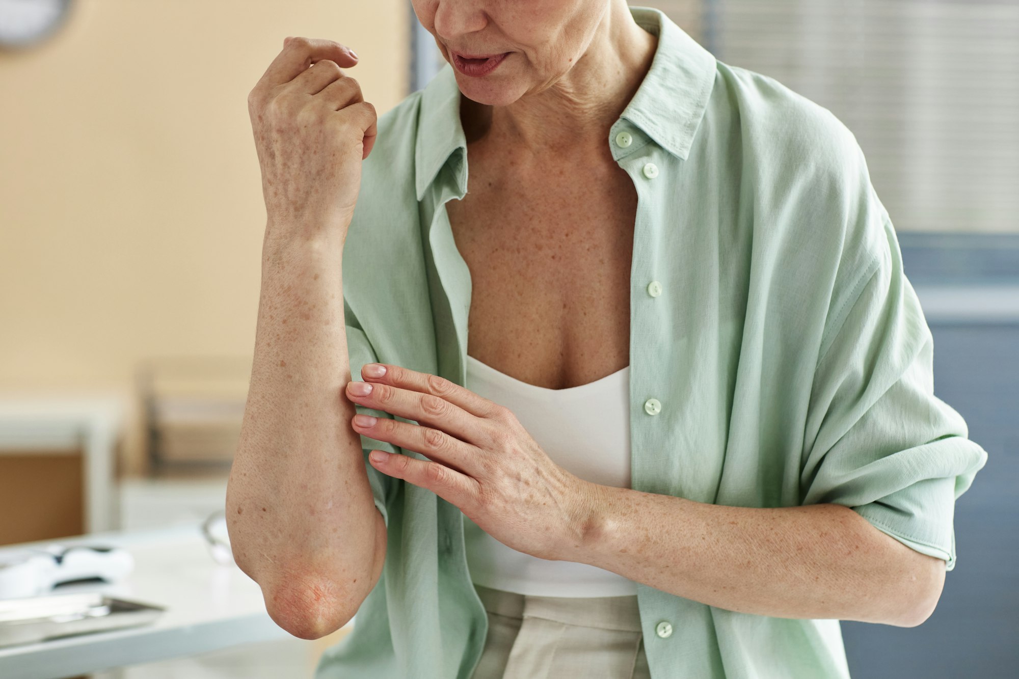 Close up of mature woman skin condition talking to doctor in dermatology clinic