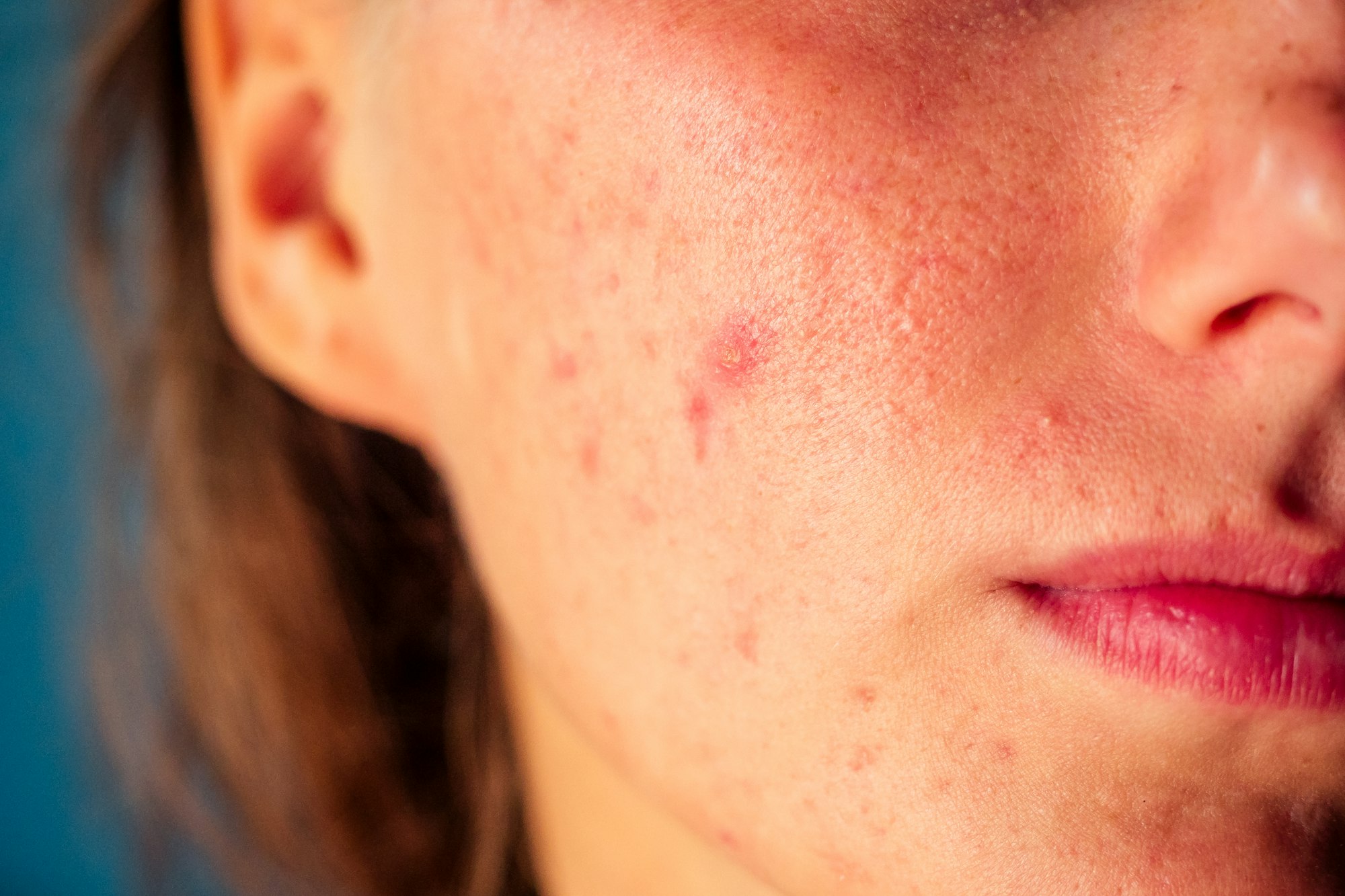 post-acne, scars and red festering pimples on the face