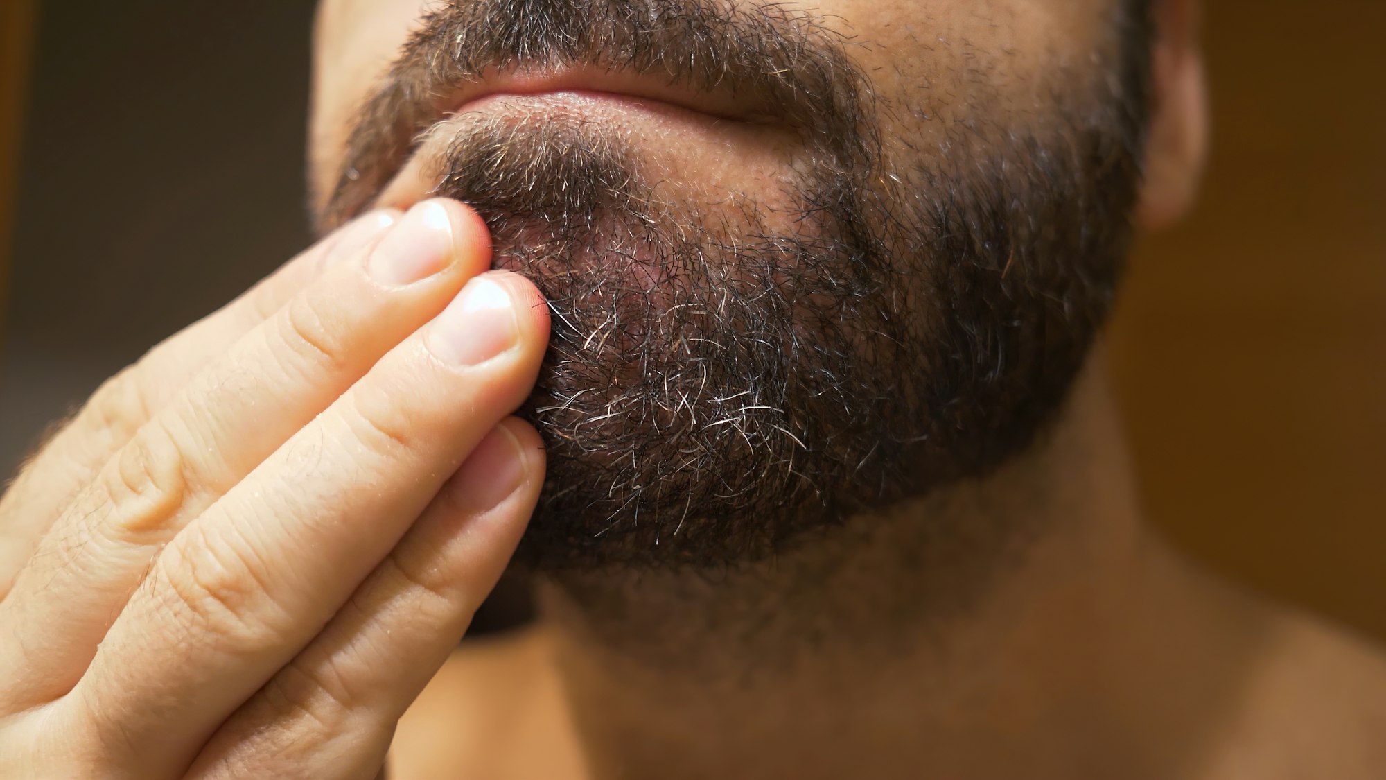 Seborrheic dermatitis in the beard