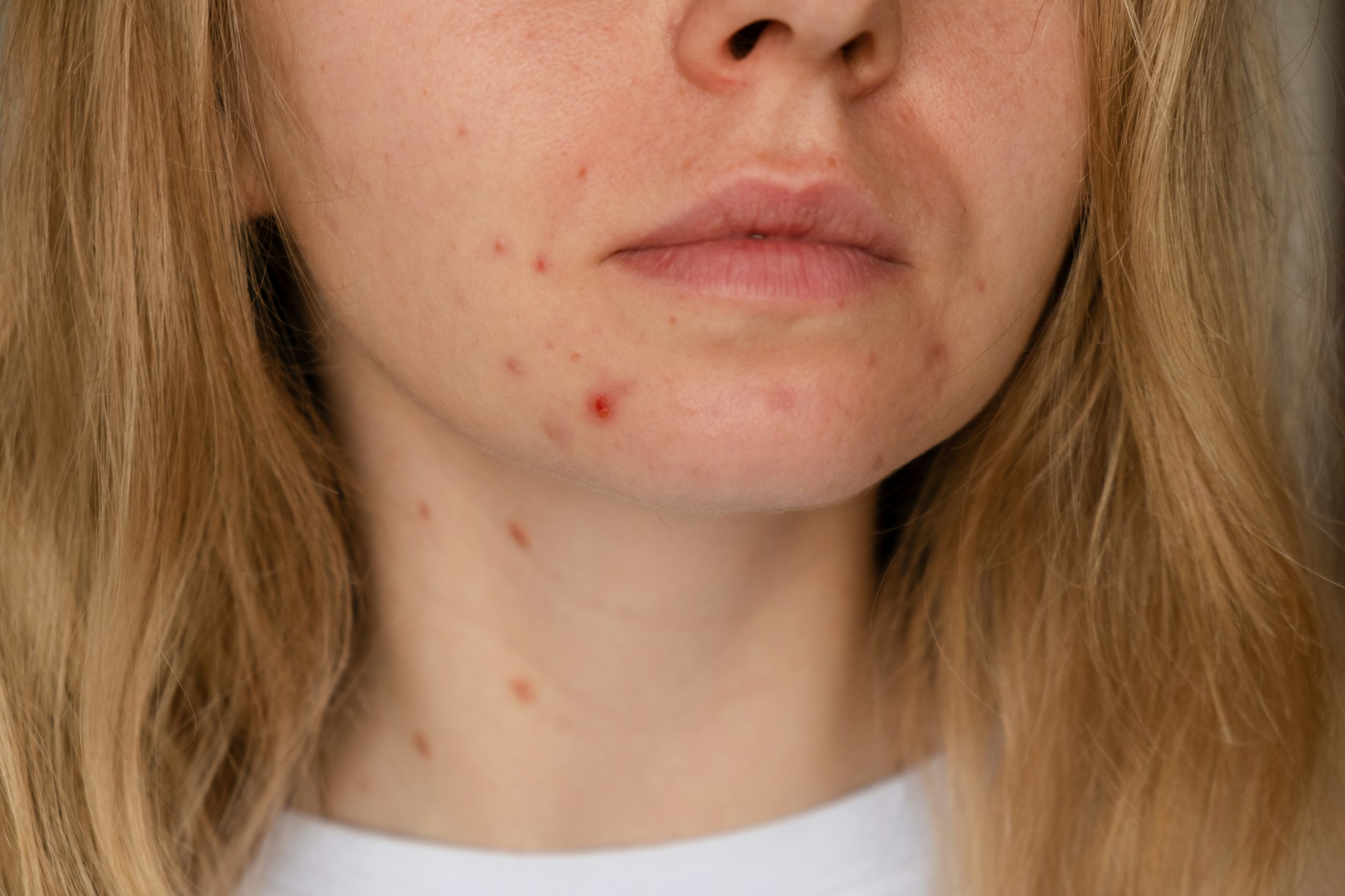 Unrecognizable woman showing her acne on face. Close-up acne on woman's face with rash skin ,scar