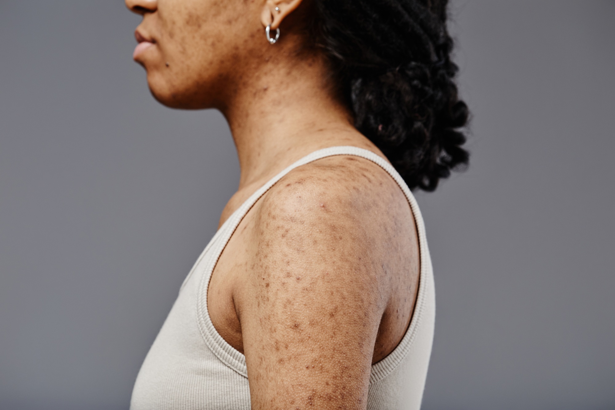 Woman with acne scars